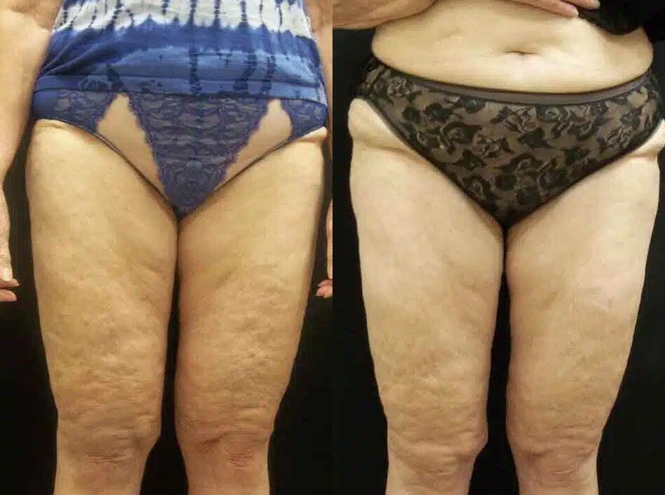 Cellulite Reduction Before & After Image