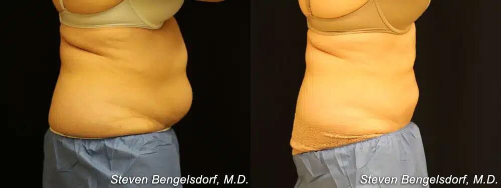 CoolSculpting Before & After Image