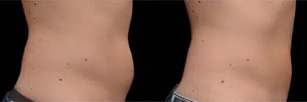 CoolSculpting Before & After Image