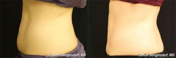 CoolSculpting Before & After Image