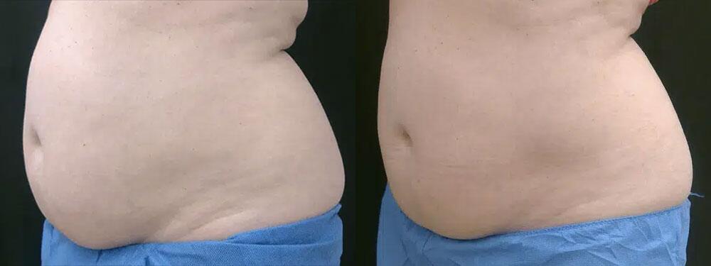 CoolSculpting Before & After Image