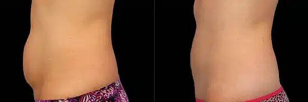 CoolSculpting Before & After Image