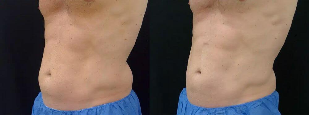 CoolSculpting Before & After Image