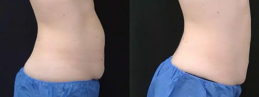 CoolSculpting Before & After Image