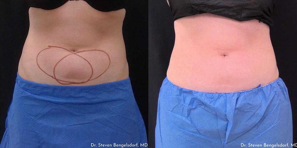 CoolSculpting Before & After Image