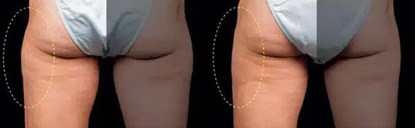 CoolSculpting Before & After Image