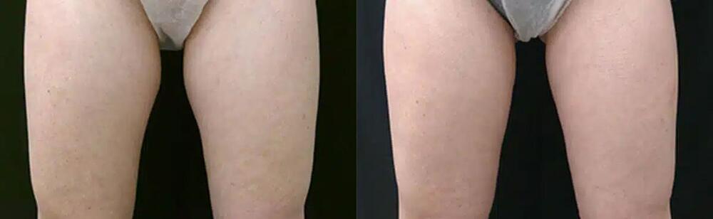 CoolSculpting Before & After Image