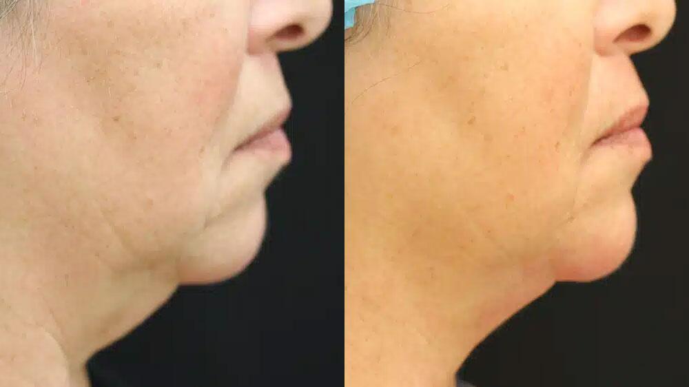 CoolSculpting Before & After Image