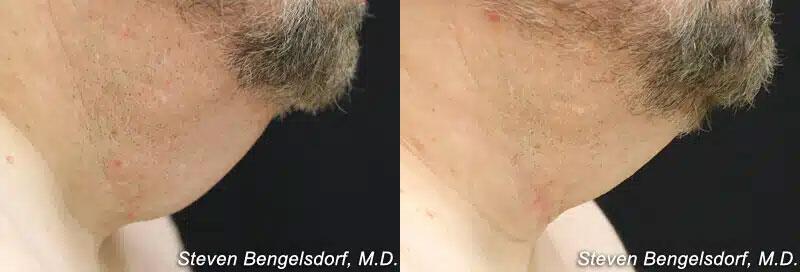 CoolSculpting Before & After Image