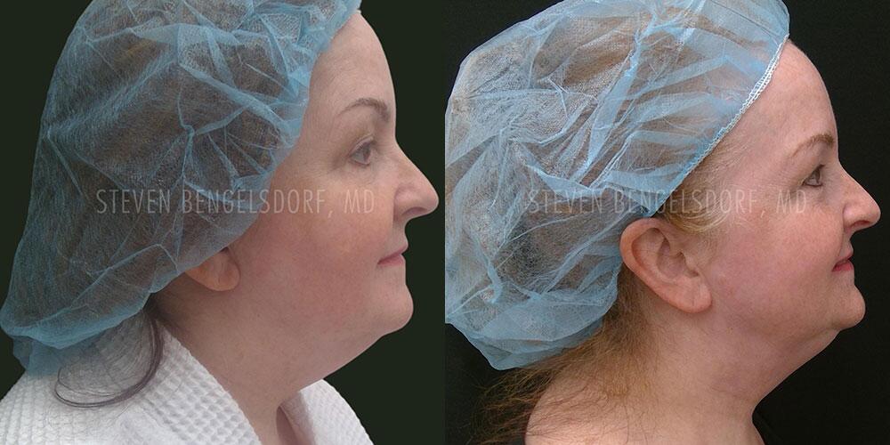 CoolSculpting Before & After Image