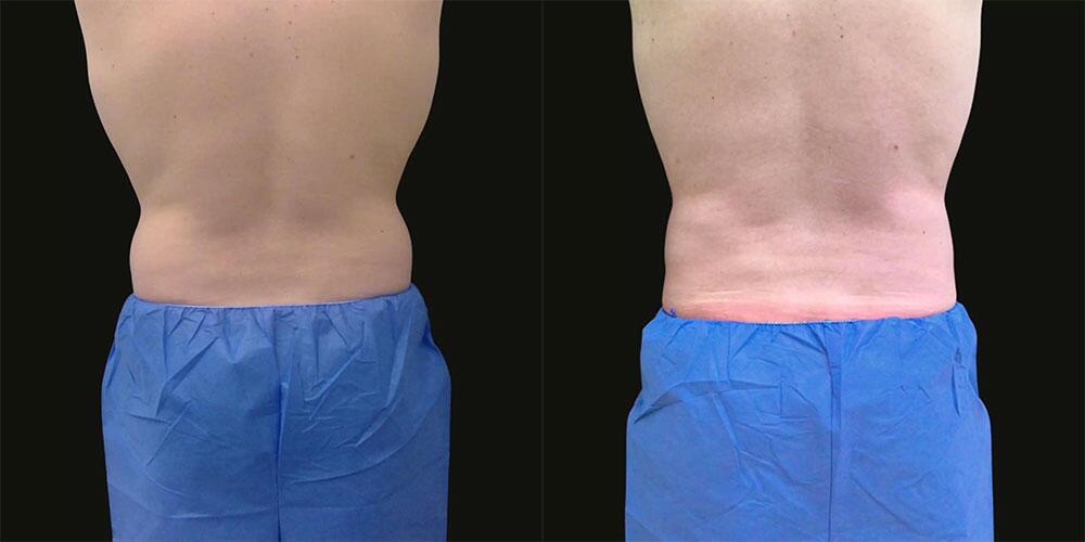 CoolSculpting Before & After Image