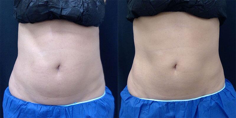 CoolSculpting Before & After Image