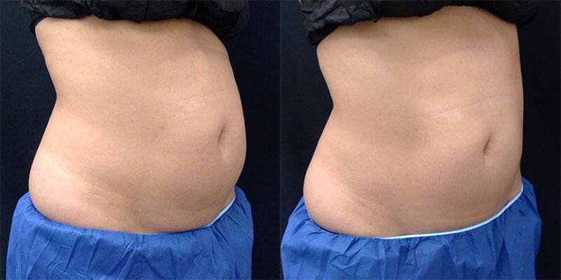 CoolSculpting Before & After Image