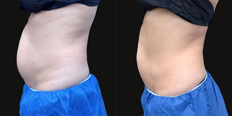 CoolSculpting Before & After Image