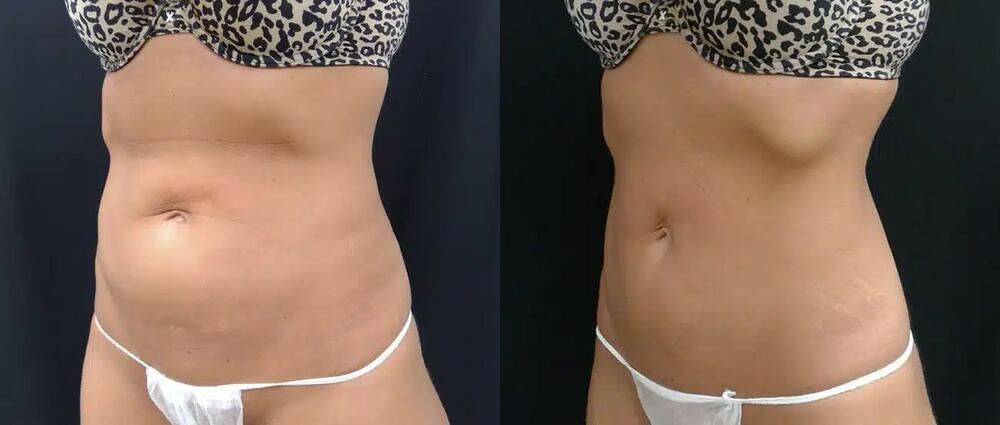 CoolTone Before & After Image