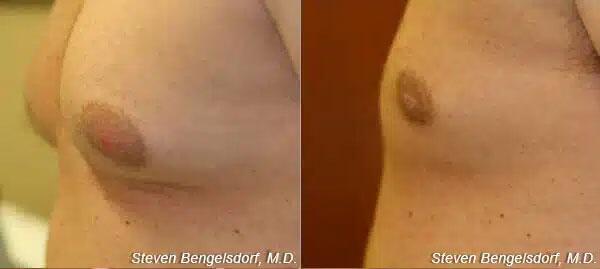 Gynecomastia Before & After Image