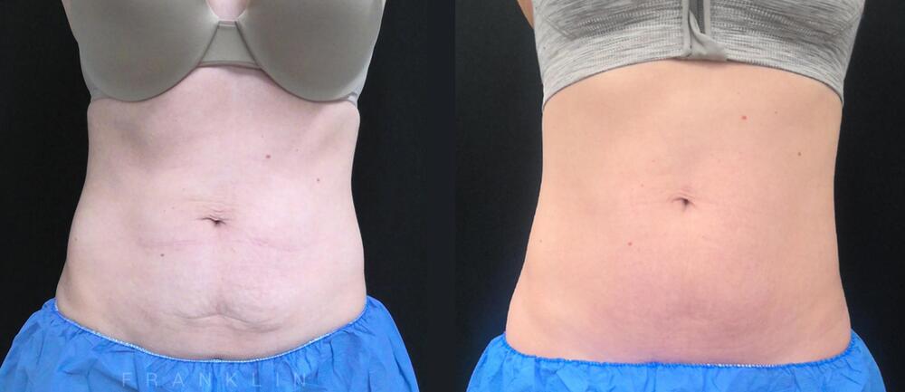 Morpheus8 Body Before & After Image