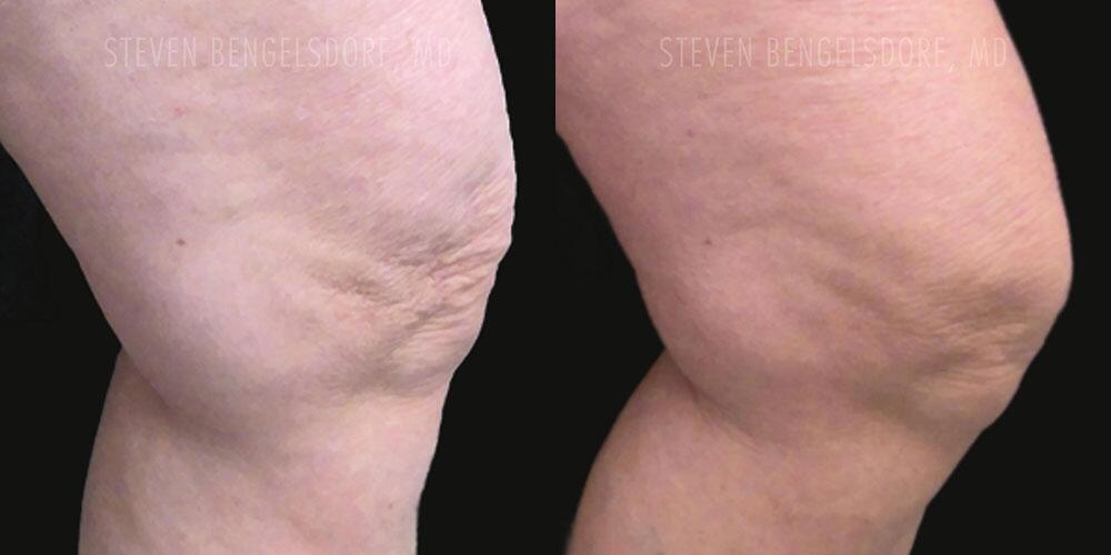 Morpheus8 Body Before & After Image