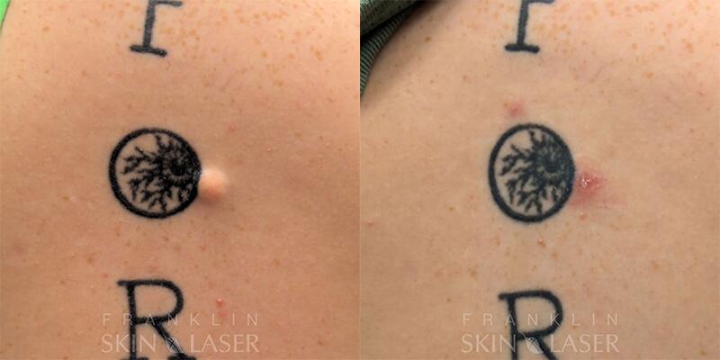 Cyst & Lipoma Removal Before & After Image