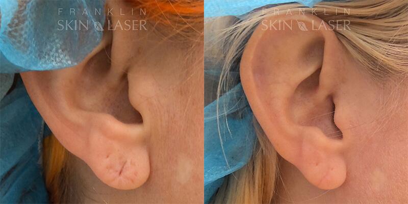 Earlobe Repair Before & After Image