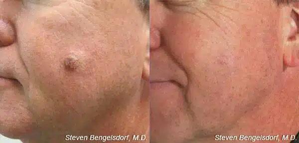 mole removal Before & After Image