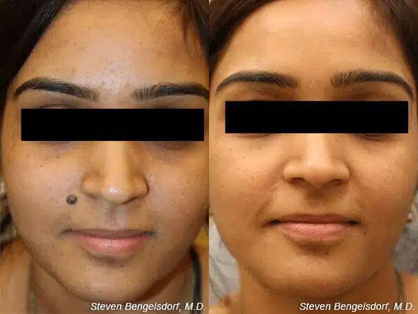 mole removal Before & After Image