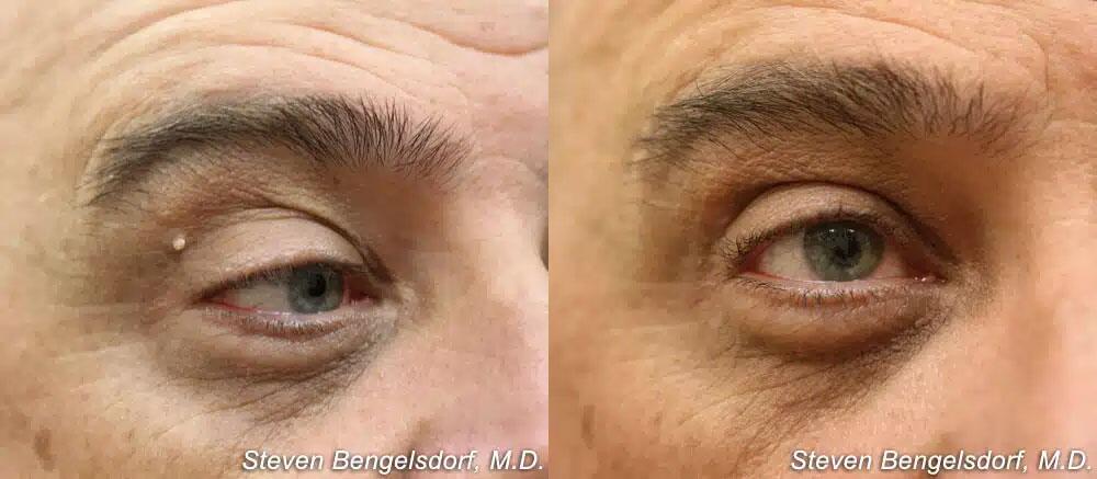 mole removal Before & After Image