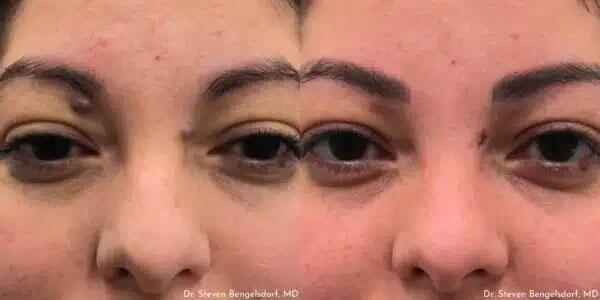 mole removal Before & After Image