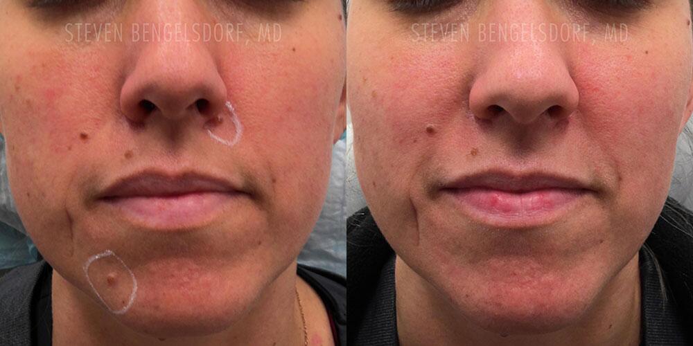 mole removal Before & After Image