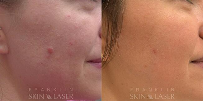 mole removal Before & After Image