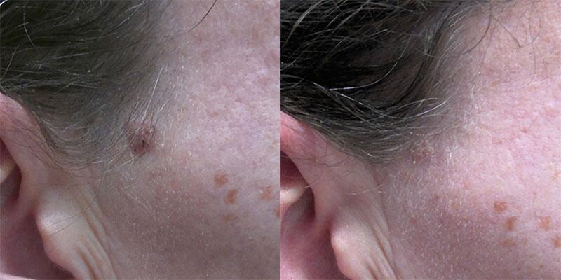 mole removal Before & After Image