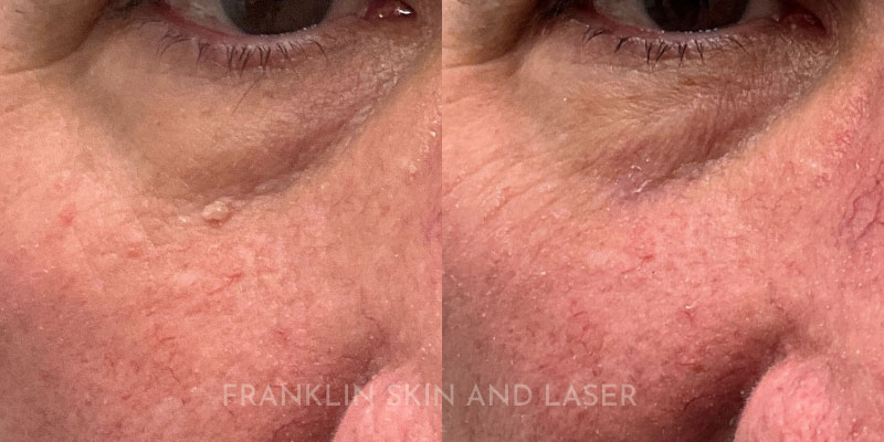 mole removal Before & After Image