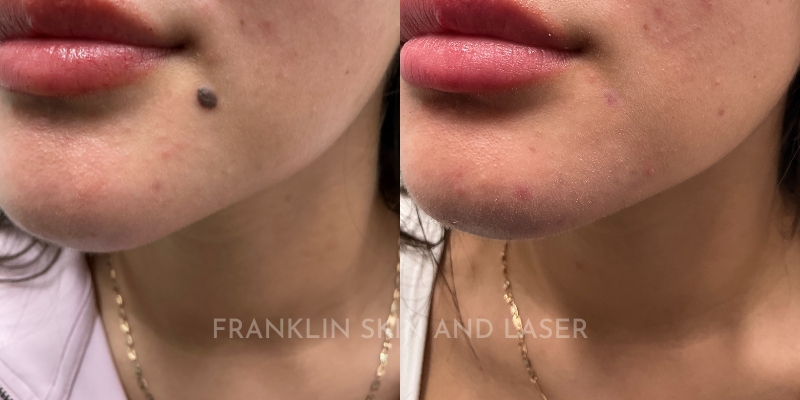 Mole Removal Before & After Image