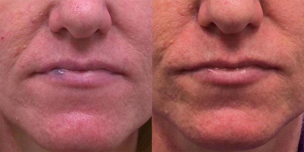 venous lake Before & After Image