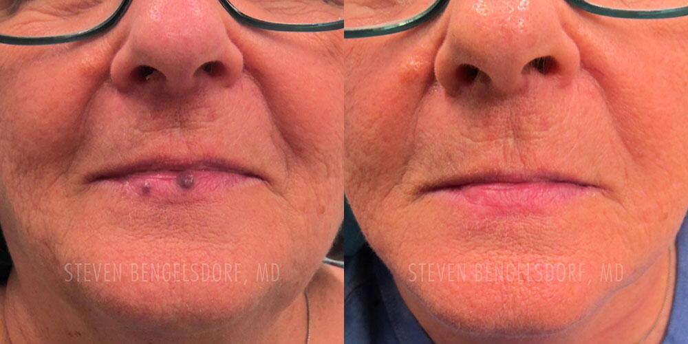 venous lake Before & After Image