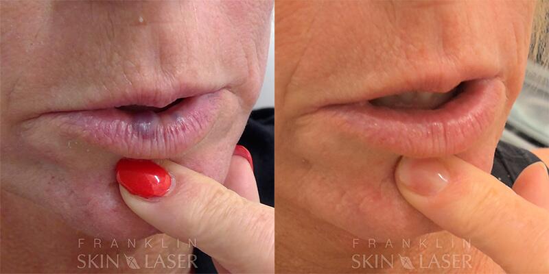 venous lake Before & After Image