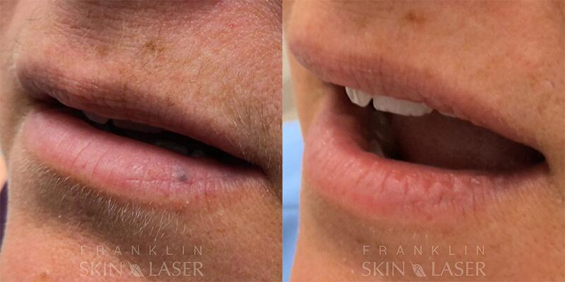 venous lake Before & After Image