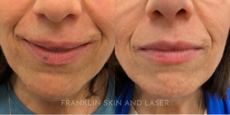 venous lake Before & After Image