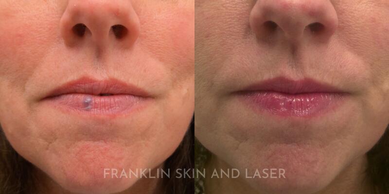 Venous Lake Removal Before & After Image