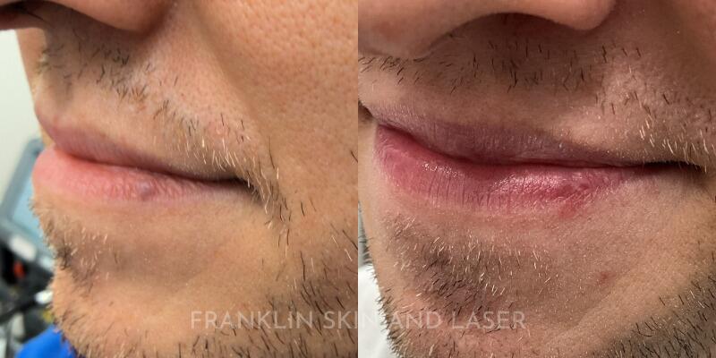 Venous Lake Removal Before & After Image