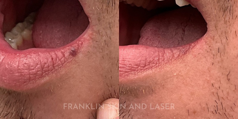 Venous Lake Removal Before & After Image