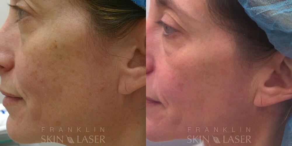 Clear Brilliant Before & After Image