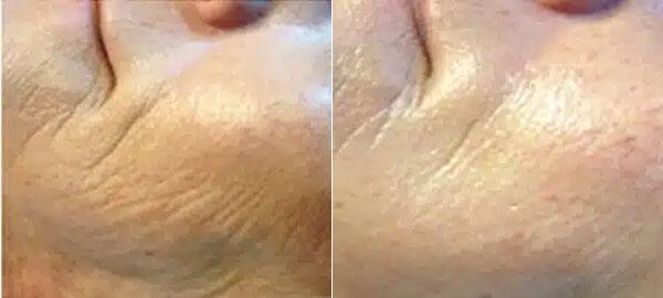 Microneedling Before & After Image