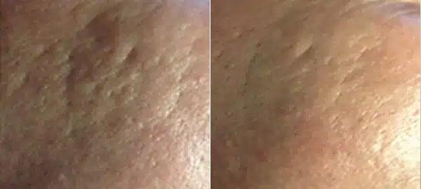 Microneedling Before & After Image