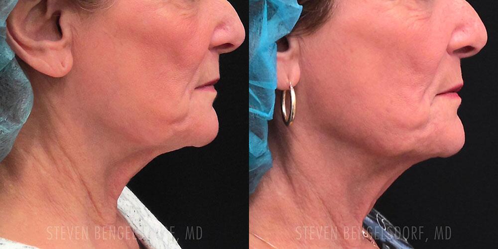 morpheus8 Before & After Image