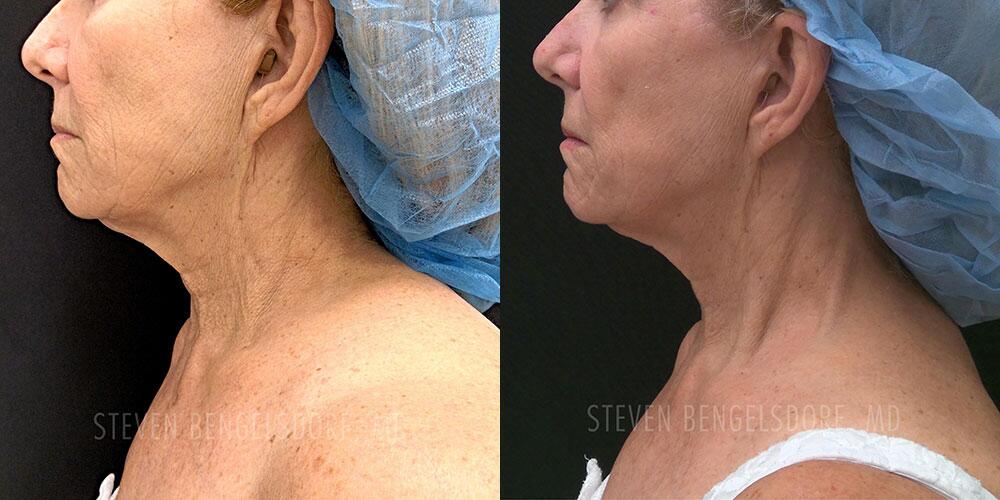 morpheus8 Before & After Image