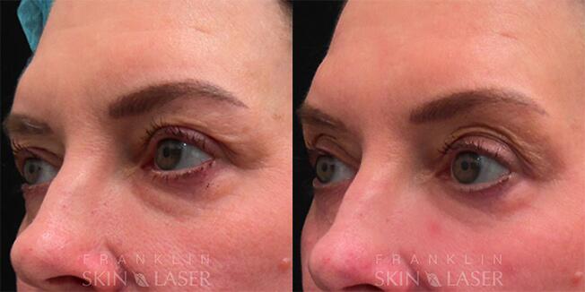 Morpheus8 Face Before & After Image