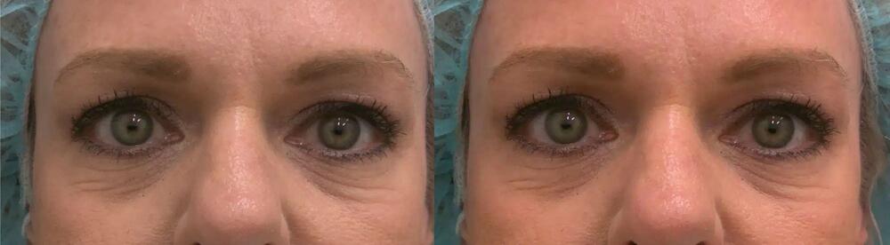 Plasma Pen Before & After Image