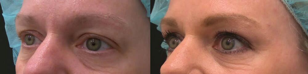 Plasma Pen Before & After Image