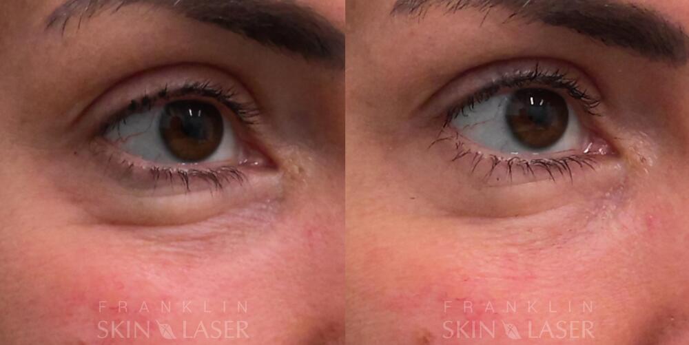 Plasma Pen Before & After Image